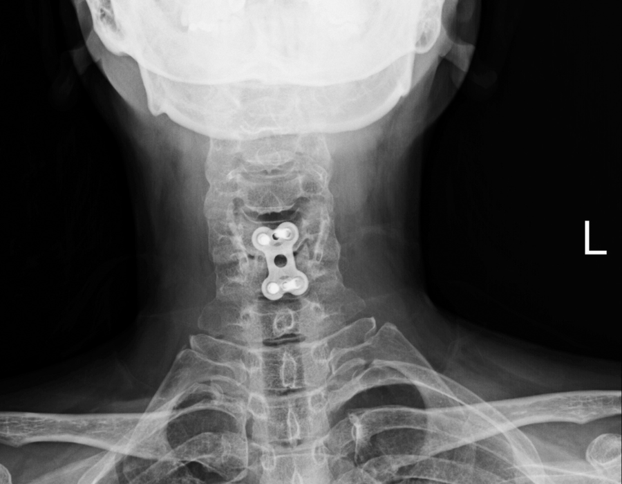 Điều trị Gai Cột Sống C5 C6 Phòng Khám MB Laser ĐỒNG XOÀI