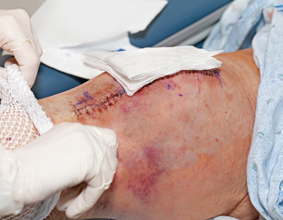 Phòng Khám MB Laser ĐỒNG XOÀI Phẫu Thuật Thay Đĩa Đệm Cột Sống Thắt Lưng