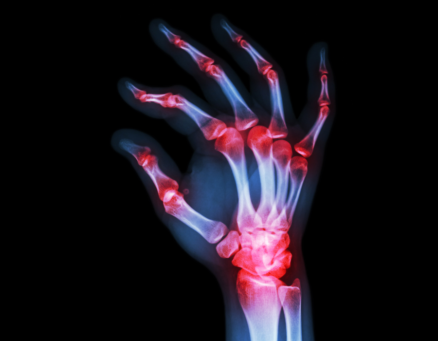 Viêm Khớp Nhiễm Khuẩn Phòng Khám MB Laser ĐỒNG XOÀI