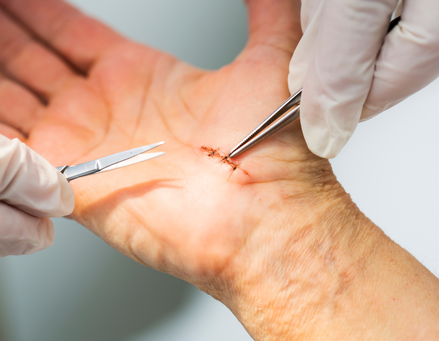 Mổ Hội Chứng Ống Cổ Tay Bao Lâu Là Lành Phòng Khám MB Laser ĐỒNG XOÀI