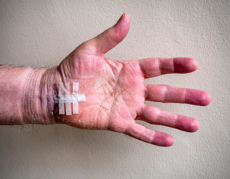 Hội Chứng Ống Cổ Tay Có Nguy Hiểm Không? Phòng Khám MB Laser ĐỒNG XOÀI