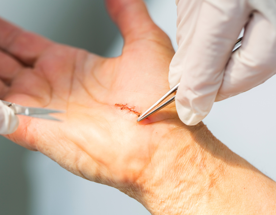 Hội Chứng Ống Cổ Tay Có Nguy Hiểm Không? Phòng Khám MB Laser ĐỒNG XOÀI