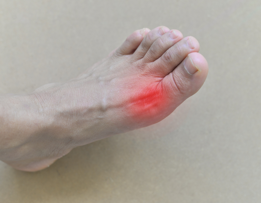 Cách Điều Trị Bệnh Gout Tại Phòng Khám MB Laser ĐỒNG XOÀI