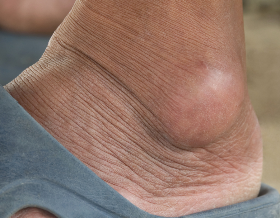 Cách Điều Trị Bệnh Gout Tại Phòng Khám MB Laser ĐỒNG XOÀI
