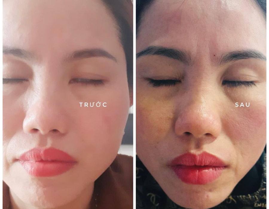 LIỆT BEEL-LIỆT DÂY THẦN KINH SỐ VII Phòng Khám MB Laser ĐỒNG XOÀi