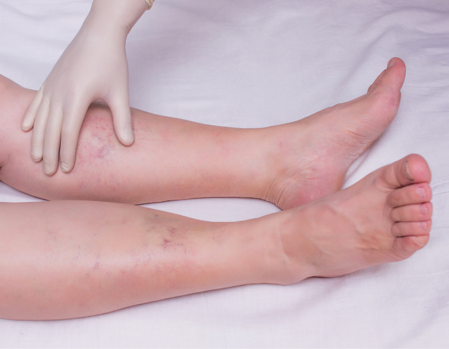 SUY GIÃN TĨNH MẠCH Phòng Khám MB Laser ĐỒNG XOÀI