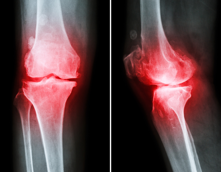 Phòng Khám MB LASER ĐỒNG XOÀI điều trị thoái hoá xương khớp 